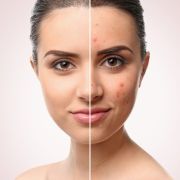 Intensive Acne Facials