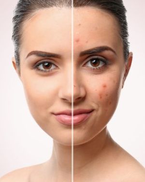 Intensive Acne Facials