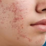 Basic Acne Facial Treatment