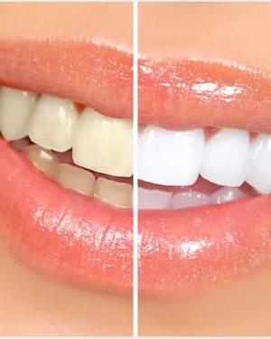 TEETH WHITENING
