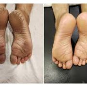 ADD-ON FOR PEDICURE AND MANICURE: Heel peel